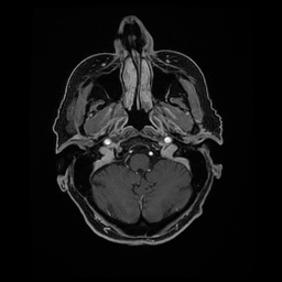 Balo concentric sclerosis (Radiopaedia 53875-59982 Axial LAVA C+ 47).jpg
