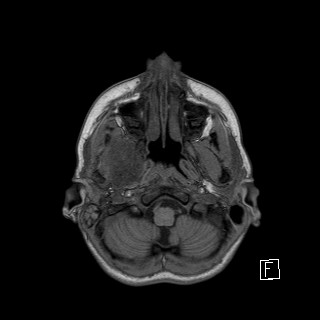 Base of skull rhabdomyosarcoma (Radiopaedia 32196-33142 Axial T1 5).jpg