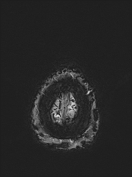 File:Basilar artery perforator aneurysm (Radiopaedia 82455-97733 Axial SWI 62).jpg