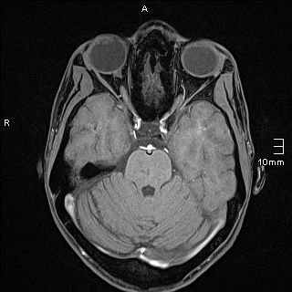 Basilar artery perforator aneurysm (Radiopaedia 82455-99523 F 44).jpg