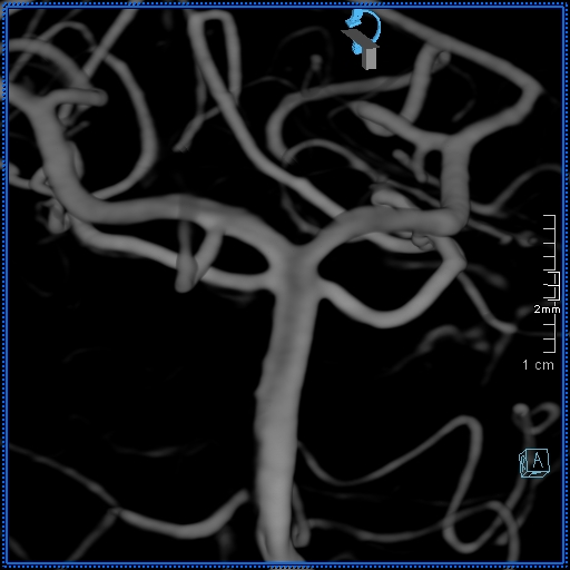 Basilar artery perforator aneurysm (Radiopaedia 82455-99524 3D Left VA 47).jpg