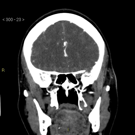 File:Basilar artery thrombosis (Radiopaedia 16260-15944 B 14).jpg