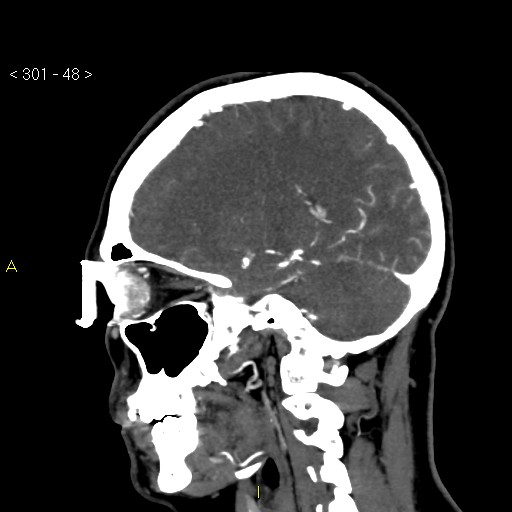 Basilar artery thrombosis (Radiopaedia 16260-15944 C 42).jpg