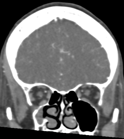 File:Basilar tip aneurysm with coiling (Radiopaedia 53912-60086 B 33).jpg