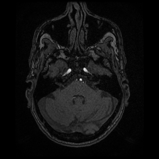 Basilar top and left middle cerebral artery aneurysm (Radiopaedia 61965-70031 Axial MRA 33).jpg