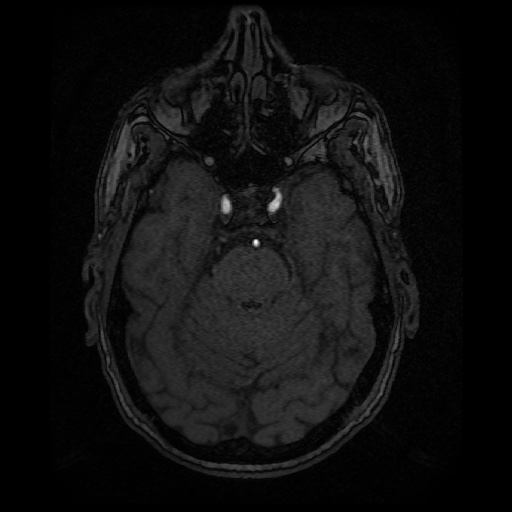 Basilar top and left middle cerebral artery aneurysm (Radiopaedia 61965-70031 Axial MRA 46).jpg