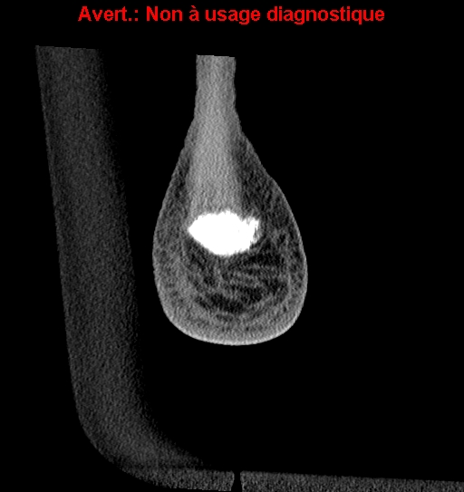 File:Baxter neuropathy (Radiopaedia 25988-26125 Coronal non-contrast 57).jpg