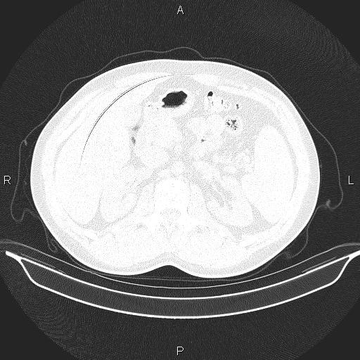 File:Beam hardening and ring artifacts (Radiopaedia 85323-100915 Axial lung window 81).jpg