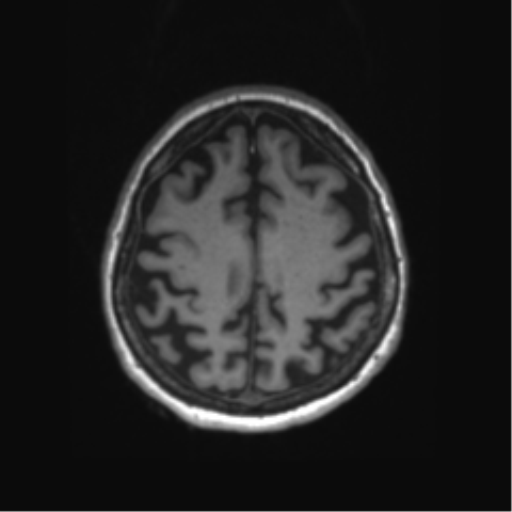 Behavioral variant frontotemporal dementia and late onset schizophrenia (Radiopaedia 52197-58083 Axial T1 18).png