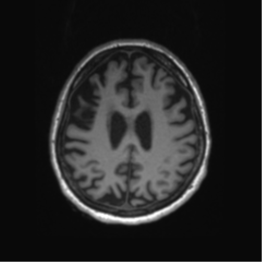 File:Behavioral variant frontotemporal dementia and late onset schizophrenia (Radiopaedia 52197-58083 Axial T1 27).png