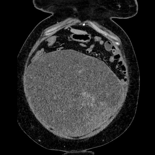 File:Benign leiomyoma with hydropic features (Radiopaedia 89250-106130 B 36).jpg