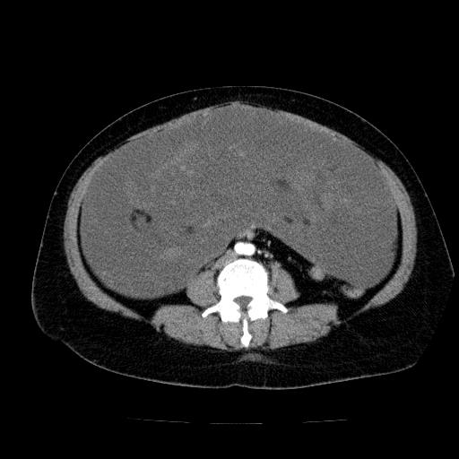 Benign spindle cell tumor - abdominopelvic (Radiopaedia 61300-69212 A 36).jpg