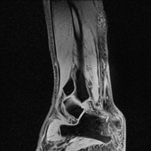 Bilateral Achilles tendon complete tear (Radiopaedia 81344-95051 Sagittal WE - Right 32).jpg