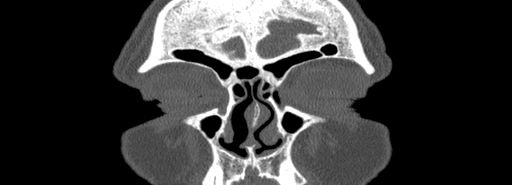 File:Bilateral Ectopic Infraorbital Nerves (Radiopaedia 49006-54084 Coronal bone window 3).jpg