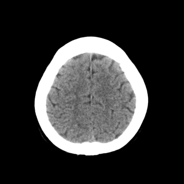File:Bilateral PCA territory infarction - different ages (Radiopaedia 46200-50591 Axial non-contrast 19).jpg