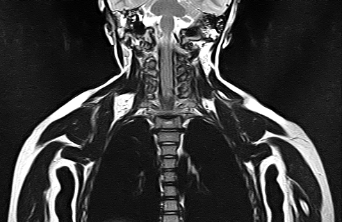 File:Bilateral Sprengel deformity with Klippel-Feil syndrome (Radiopaedia 66395-75650 Coronal T2 15).jpg