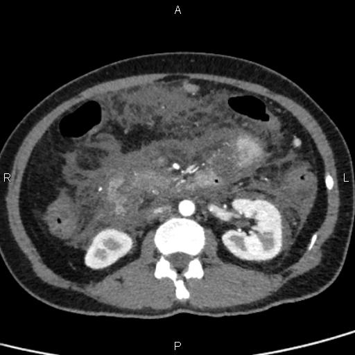 Bilateral adrenal gland hyperenhancement in pancreatitis (Radiopaedia 86642-102753 B 64).jpg