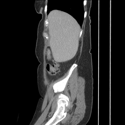 Bilateral adrenal granulocytic sarcomas (chloromas) (Radiopaedia 78375-91007 C 35).jpg