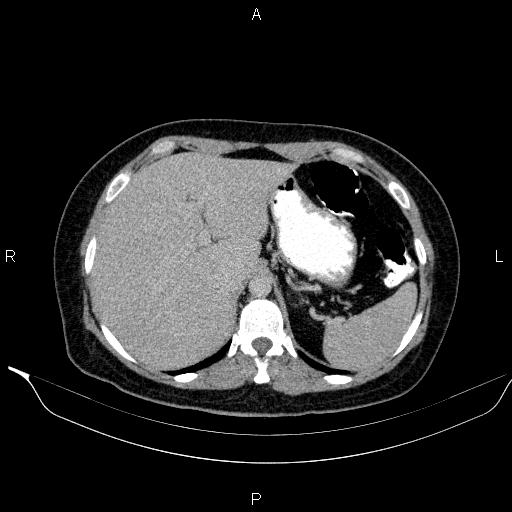 Bilateral adrenal myelolipoma (Radiopaedia 63058-71535 Axial C+ delayed 13).jpg