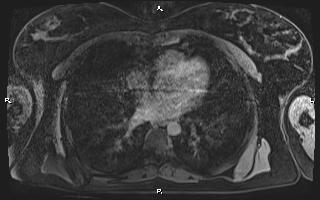 File:Bilateral adrenal myelolipoma (Radiopaedia 63058-71537 H 1).jpg