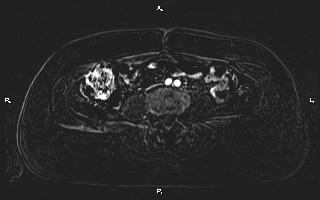 Bilateral adrenal myelolipoma (Radiopaedia 63058-71537 I 73).jpg