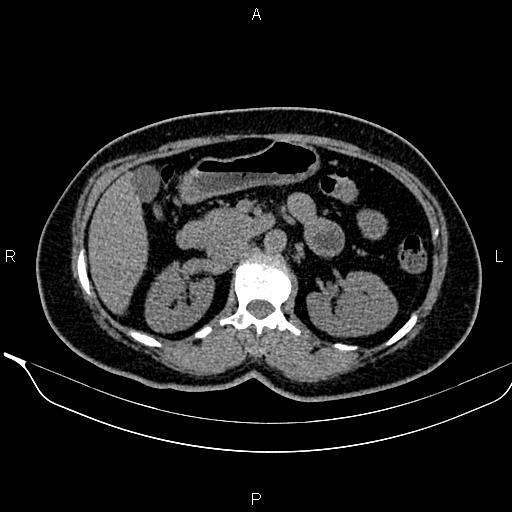 Bilateral benign adrenal adenomas (Radiopaedia 86912-103124 Axial non-contrast 45).jpg
