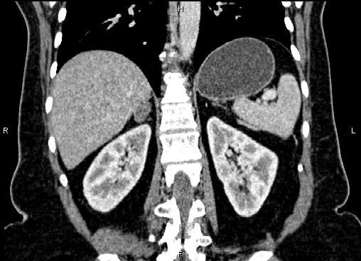 Bilateral benign adrenal adenomas (Radiopaedia 86912-103124 D 43).jpg