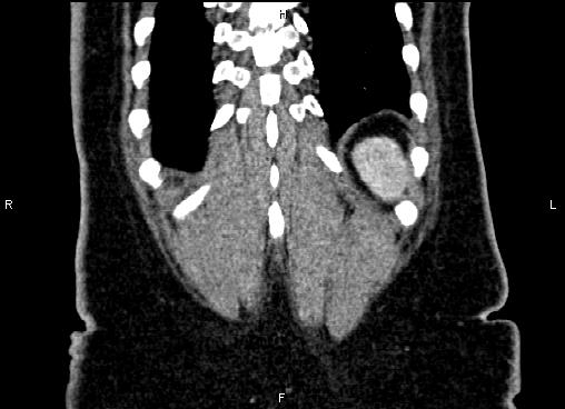 Bilateral benign adrenal adenomas (Radiopaedia 86912-103124 D 60).jpg