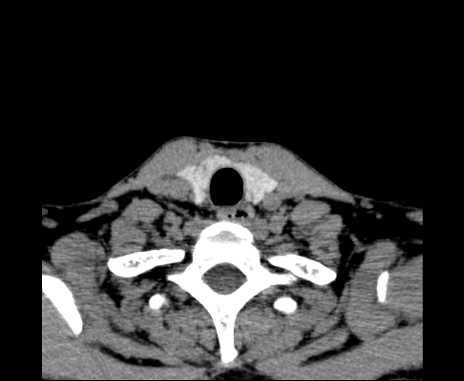 Bilateral carotid body tumors (Radiopaedia 61841-69870 Axial non-contrast 97).jpg