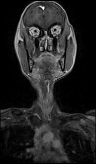 Bilateral carotid body tumors and right glomus jugulare tumor (Radiopaedia 20024-20060 MRA 5).jpg