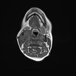 File:Bilateral carotid body tumors and right jugular paraganglioma (Radiopaedia 20024-20060 Axial 1).jpg
