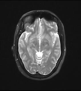 File:Bilateral carotid body tumors and right jugular paraganglioma (Radiopaedia 20024-20060 Axial 14).jpg