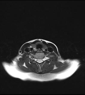 File:Bilateral carotid body tumors and right jugular paraganglioma (Radiopaedia 20024-20060 Axial 48).jpg