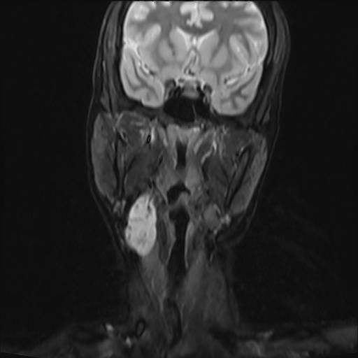 File:Bilateral carotid body tumors and right jugular paraganglioma (Radiopaedia 20024-20060 Coronal 32).jpg