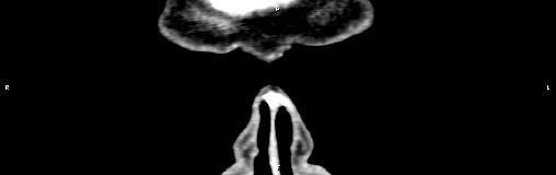 File:Bilateral enlargement of lacrimal glands - sarcoidosis (Radiopaedia 62627-70921 Coronal non-contrast 2).jpg