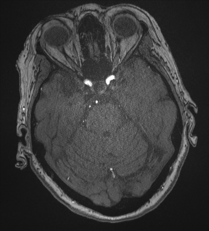 Bilateral fetal posterior communicating arteries (Radiopaedia 41286-44102 Axial MRA 64).png
