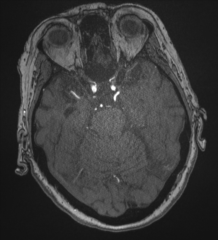 Bilateral fetal posterior communicating arteries (Radiopaedia 41286-44102 Axial MRA 69).png