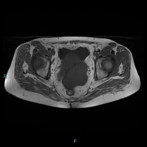 File:Bilateral ovarian fibroma (Radiopaedia 44568-48293 Axial T1 18).jpg