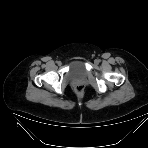 Bilateral ovarian mature cystic teratomas (Radiopaedia 79373-92457 Axial non-contrast 90).jpg