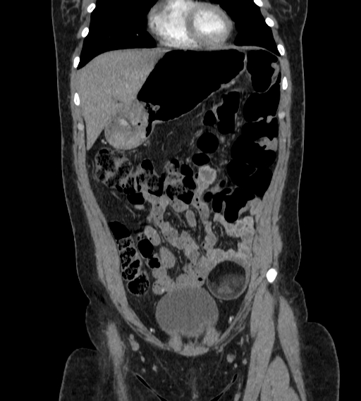 Bilateral ovarian mature cystic teratomas (Radiopaedia 79373-92457 B 10).jpg
