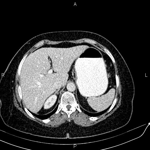Bilateral ovarian serous cystadenocarcinoma (Radiopaedia 86062-101989 B 23).jpg