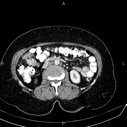 Bilateral ovarian serous cystadenocarcinoma (Radiopaedia 86062-101989 B 48).jpg