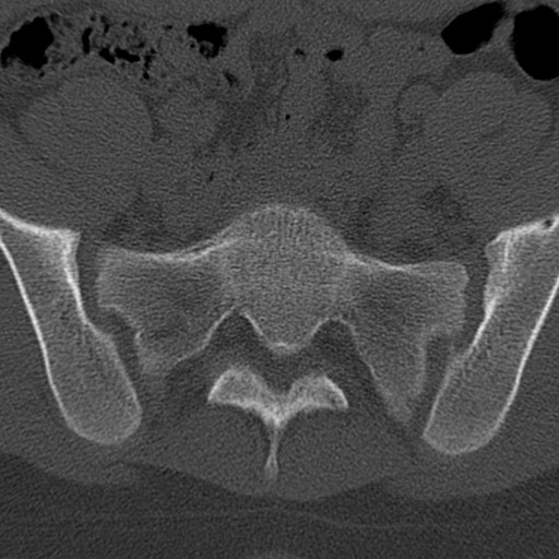 Bilateral pars defect (Radiopaedia 26691-26846 Axial bone window 86).jpg