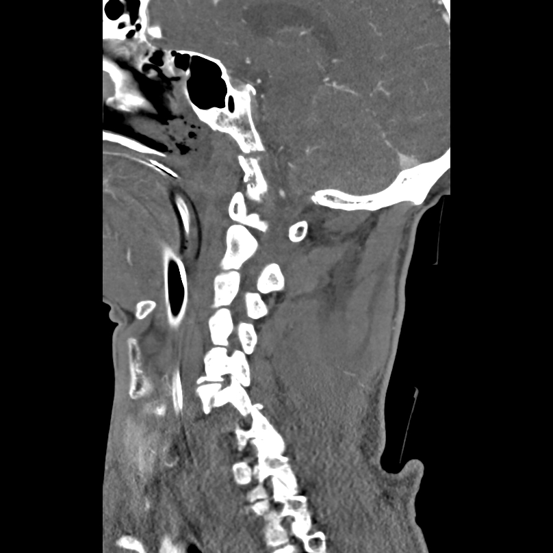 Bilateral perched facets with cord injury (Radiopaedia 45587-49713 B 19).jpg