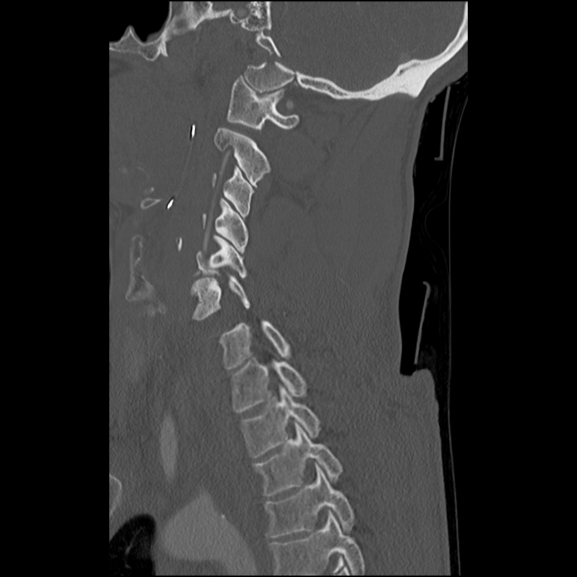 Bilateral perched facets with cord injury (Radiopaedia 45587-49713 Sagittal bone window 34).jpg