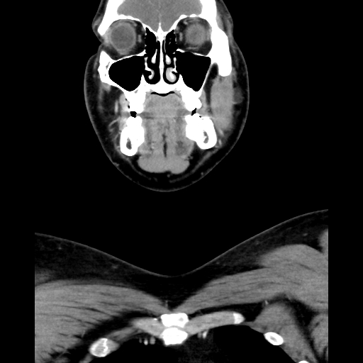 Bilateral peritonsillar abscess (Radiopaedia 85065-100610 Coronal 20).jpg