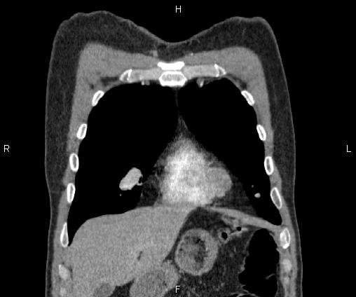 Bilateral pulmonary AVM (Radiopaedia 83134-97505 C 17).jpg