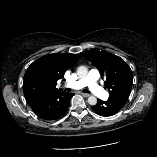 Bilateral pulmonary emboli (Radiopaedia 32700-33669 Axial C+ CTPA 46).jpg