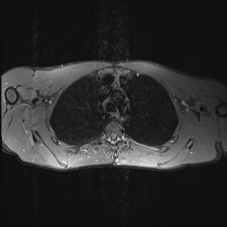 File:Bilateral spinoglenoid notch ganglion cysts (Radiopaedia 29577-30082 Axial STIR 25).jpg