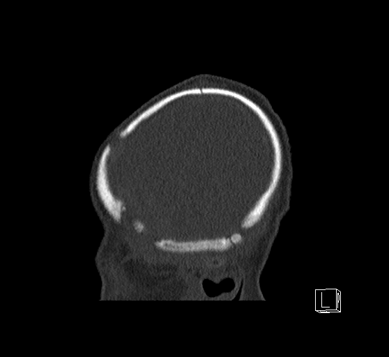 Bilateral subdural hemorrhage and parietal skull fracture (Radiopaedia 26058-26192 Sagittal bone window 87).png